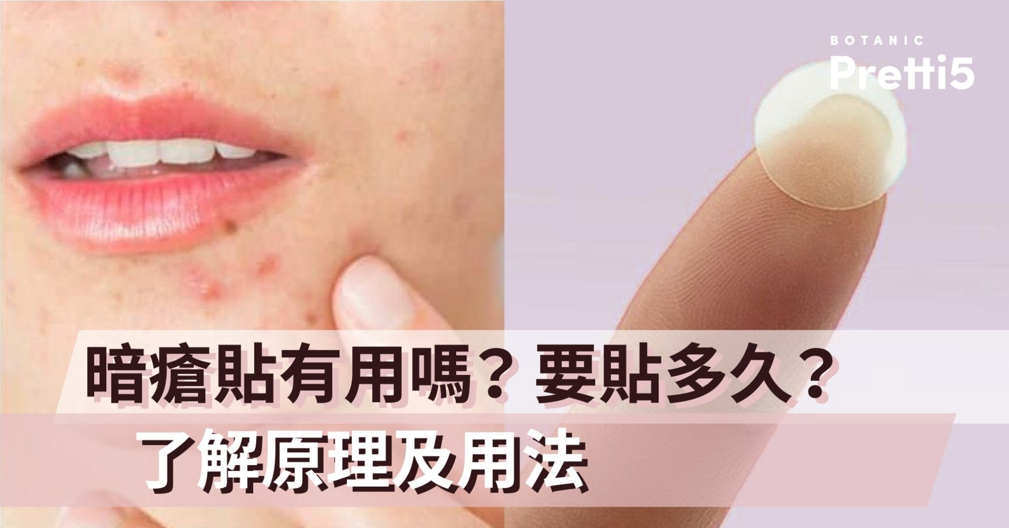 暗瘡貼有用嗎？要貼多久？了解原理及用法 - Pretti5 - HK